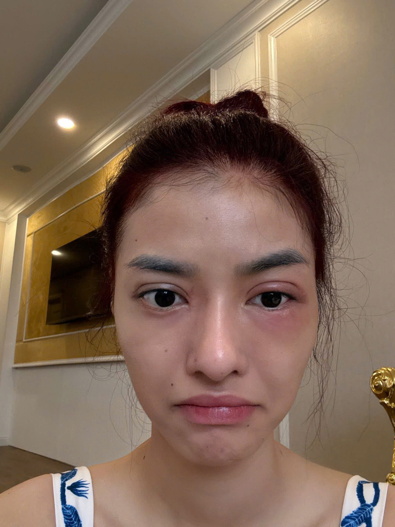 Á hậu Kiều Loan gây hoang mang với gương mặt sưng vù