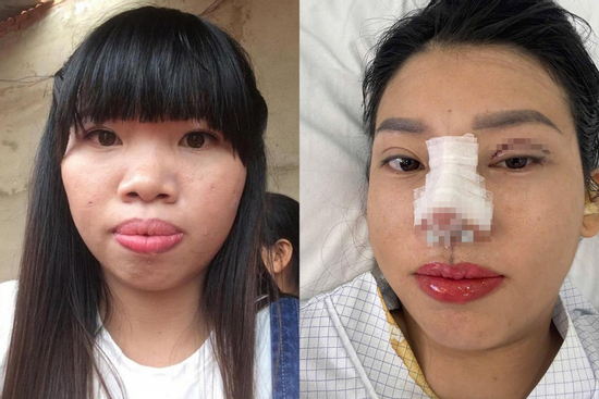 'Thị Nở tái sinh' Quách Phượng tiếp tục phẫu thuật thẩm mỹ, diện mạo mới gây bất ngờ