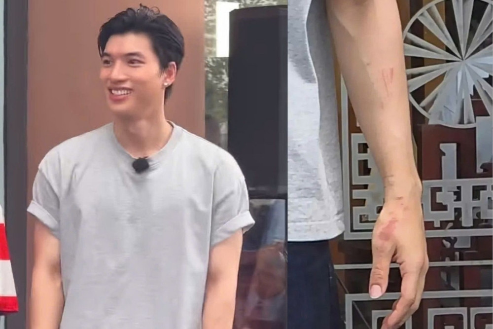 Lê Dương Bảo Lâm đính chính vết thương ở tay của HIEUTHUHAI