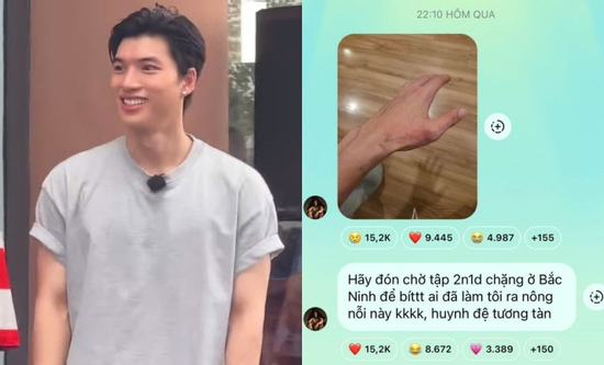 Lê Dương Bảo Lâm đính chính vết thương ở tay của HIEUTHUHAI