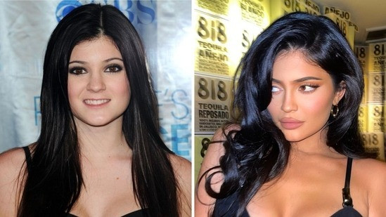 kylie jenner plastic surgery 175