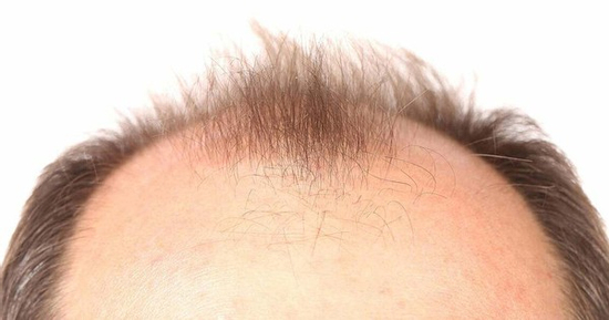 Đồ uống có đường - 'thủ phạm' gây rụng tóc ở nam giới