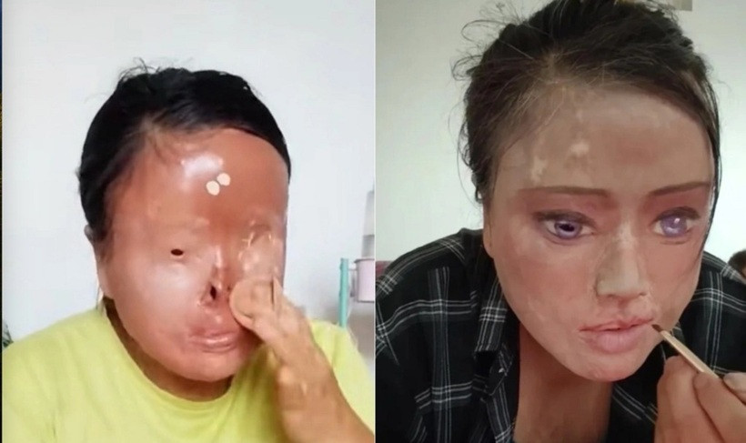 Từng muốn quyên sinh khi gương mặt bị axit hủy hoại hoàn toàn, Ah Hua tìm thấy ánh sáng cuộc đời nhờ những nét vẽ