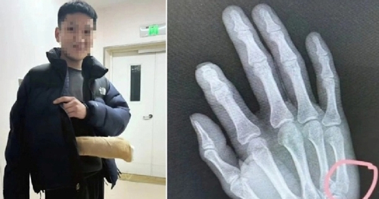 Phẫn nộ vì kèm con học bài, người đàn ông đập bàn đến gãy tay