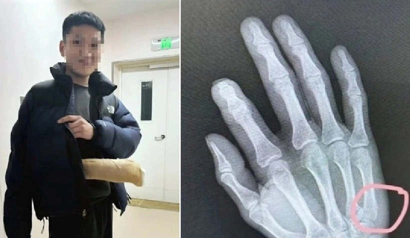 Cha nhập viện cấp cứu vì gãy xương tay sau một buổi dạy con học bài. Ảnh: Sina.