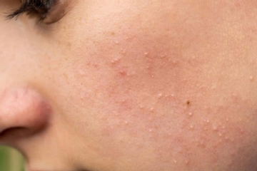 Mụn ẩn dưới da: 'Kẻ thù vô hình' của làn da và 3 bước xử lý hiệu quả