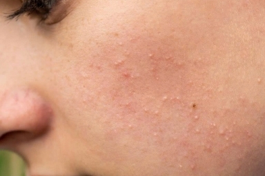 Mụn ẩn dưới da: 'Kẻ thù vô hình' của làn da và 3 bước xử lý hiệu quả