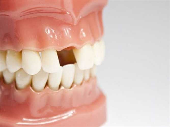 Rụng răng: Nếu bạn thường xuyên có một giấc mơ như răng tự rụng hoặc bị nhổ có nghĩa là bạn sợ mất một đồ vật hoặc một người nào đó thân thiết với bạn. Thông thường, giấc mơ này cũng được liên kết với những lo lắng về tài chính và tiền bạc.