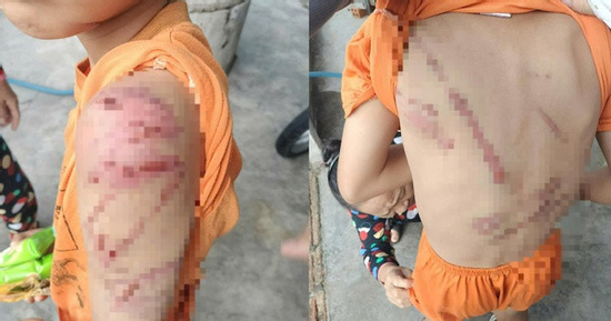 Xót xa hình ảnh cháu trai nghi bị cha đánh bầm tím khắp người