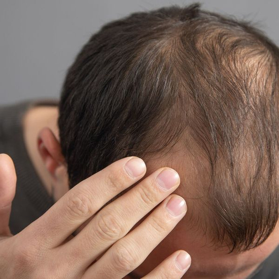 5 món ăn khiến tóc rụng lả tả nếu ăn quá thường xuyên: Toàn món khoái khẩu của nhiều người