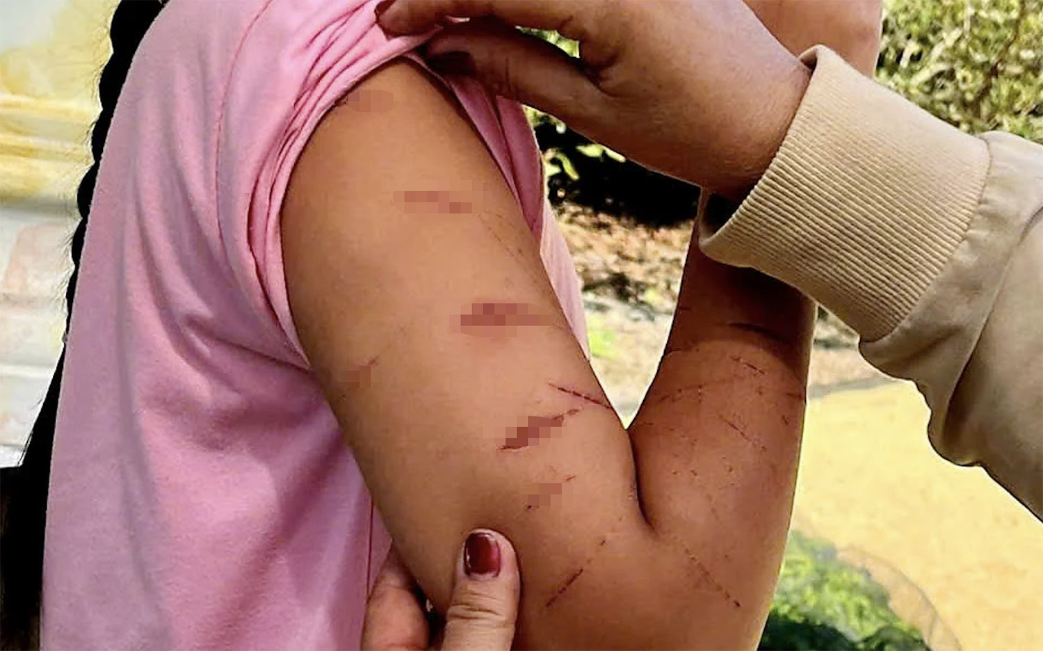vết thương trên người nữ sinh.jpg