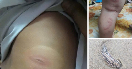 Bệnh viện lên tiếng về thông tin sâu biển cắn bé 3 tuổi nguy kịch, cần truyền máu gấp