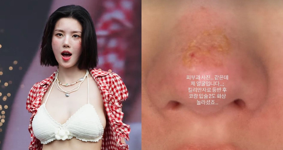 Nữ ca sĩ 31 tuổi bị bỏng nặng sau chuyến leo núi