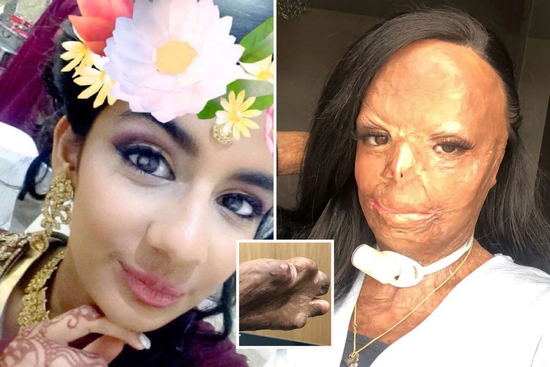 Dầu gội đầu bắt lửa, cô gái bị bỏng nửa người và mất 7 ngón tay