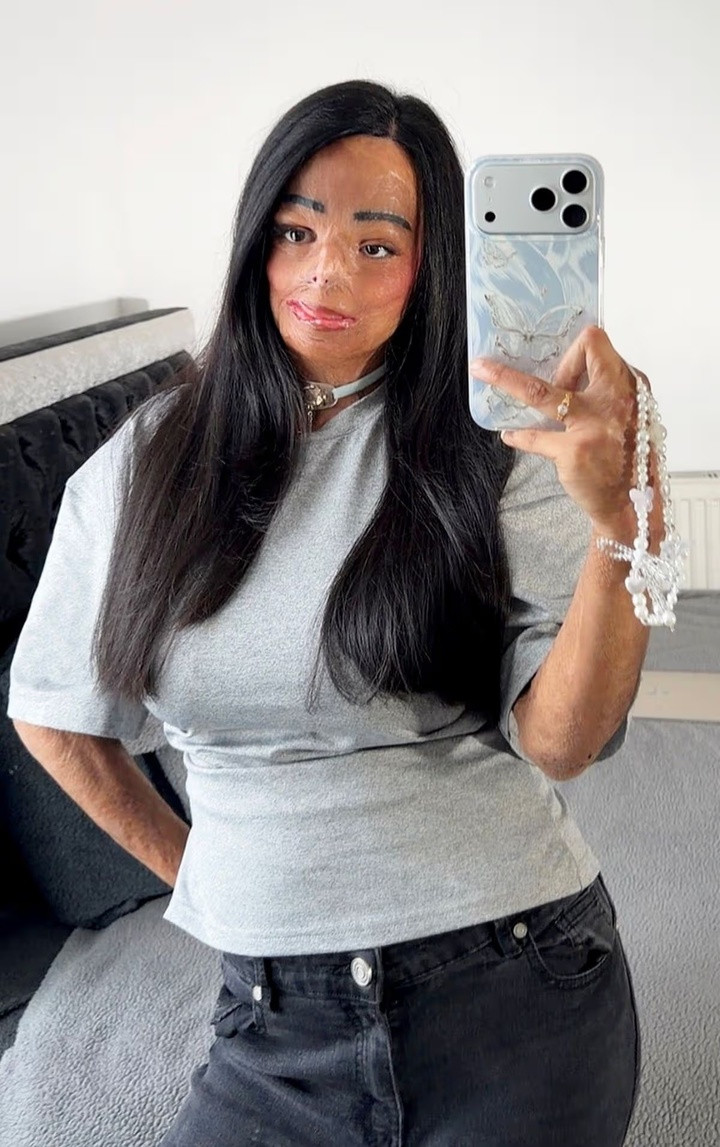 Aleema bị mất bảy ngón tay sau khi tóc cô bị bắt lửa.