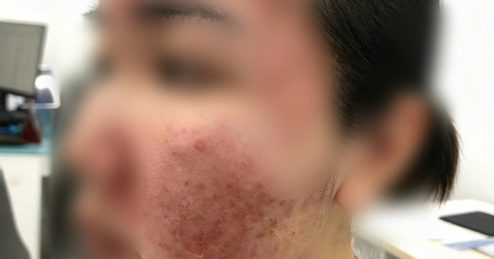 Cơn ác mộng của thiếu nữ chỉ sau vài giờ được mời làm đẹp cấp tốc đón Tết