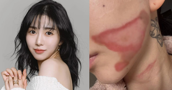 Gương mặt nữ ca sĩ 33 tuổi bị bỏng nghiêm trọng sau thẩm mỹ