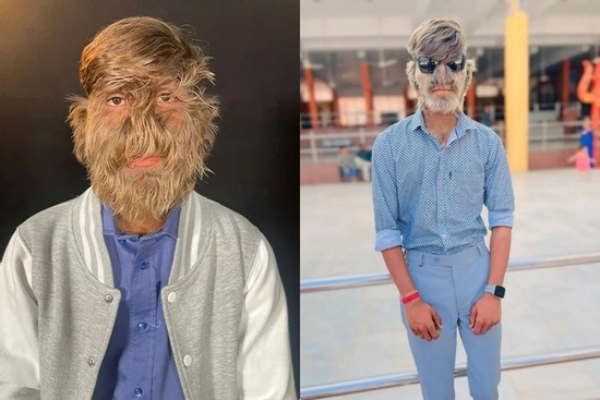 Ngỡ ngàng trước cuộc sống của chàng trai nhiều lông nhất thế giới