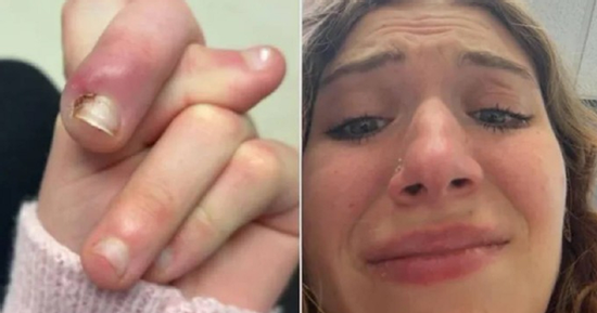 Người phụ nữ 21 tuổi suýt mất ngón vì thói quen 'vạn người mê'