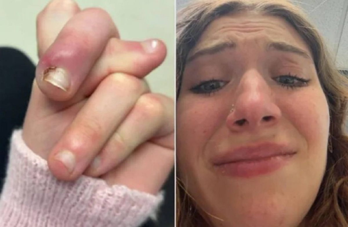 Người phụ nữ 21 tuổi suýt mất ngón vì thói quen