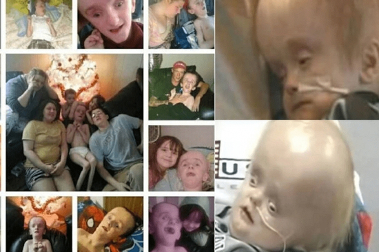 Cậu bé sinh ra không có não sống 12 năm cuộc đời thế nào?