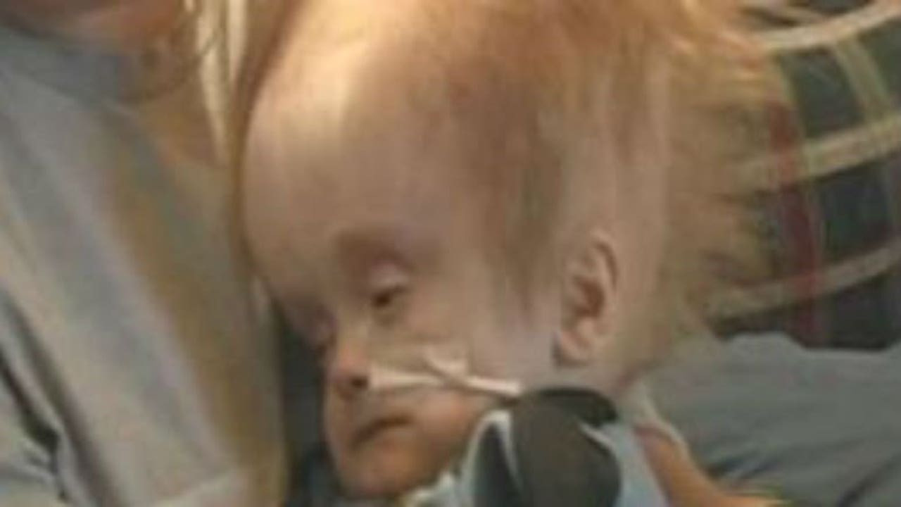 Cậu bé sinh ra không có não đã sống cuộc đời như thế nào?- Ảnh 2.