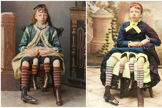 Cô gái bốn chân, sở hữu hai tử cung, sinh hạ 7 người con khiến y học kinh ngạc