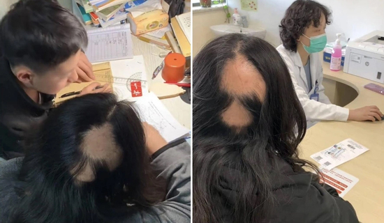 Người mẹ rụng tóc cả mảng lớn do áp lực con 'học dốt', phải kèm con học khuya