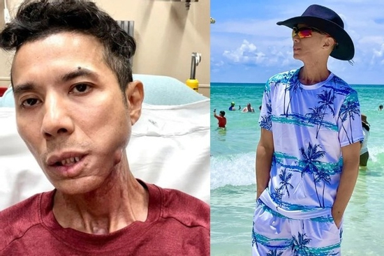 Những ngày cuối đời của ca sĩ Kasim Hoàng Vũ: Khuôn mặt biến dạng, bế tắc vì chi phí chữa trị hàng tỷ đồng