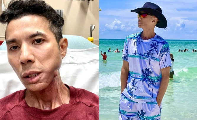 Những ngày cuối đời của ca sĩ Kasim Hoàng Vũ: Khuôn mặt biến dạng, bế tắc vì chi phí chữa trị hàng tỷ đồng - Ảnh 2