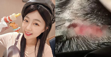 Nữ diễn viên 38 tuổi ngã đập đầu, khâu 5 mũi ngay sinh nhật