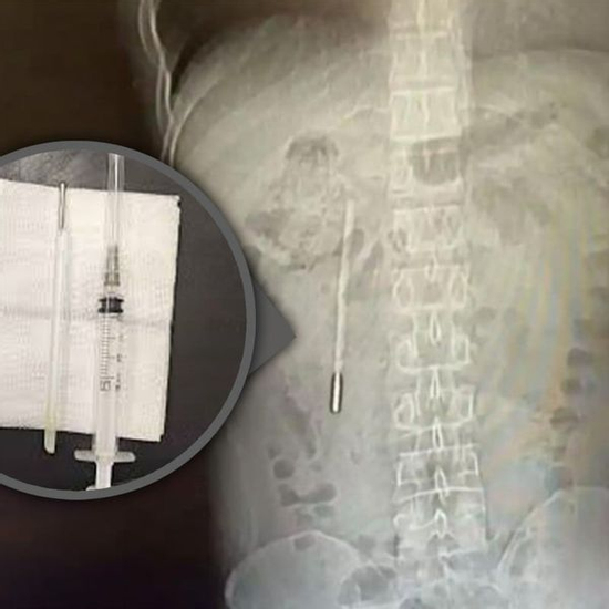 Đi viện vì đau dạ dày, người đàn ông bất ngờ phát hiện chiếc nhiệt kế thủy ngân nằm trong bụng suốt hai mươi năm