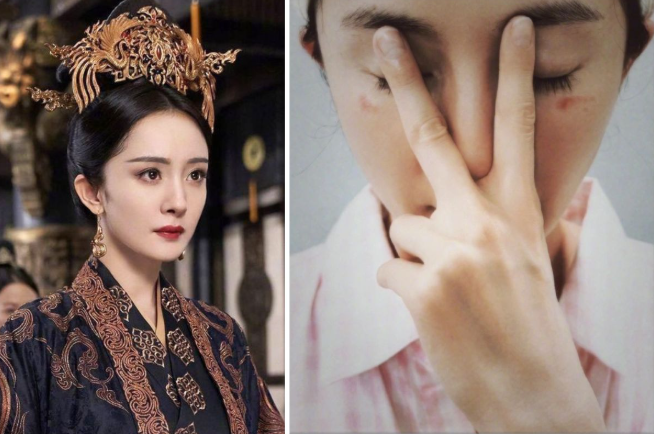 Dương Mịch bị bỏng mặt vì sử dụng mặt nạ hơi nước - Ảnh 1