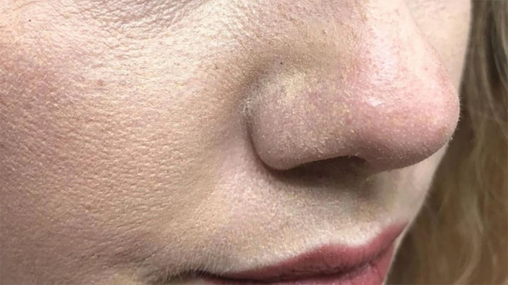 Để hạn chế kem chống nắng bị vón cục, nên cấp ẩm nhẹ trước khi thoa, đồng thời chờ các bước skincare thẩm thấu hoàn toàn để tránh xung đột giữa các lớp sản phẩm