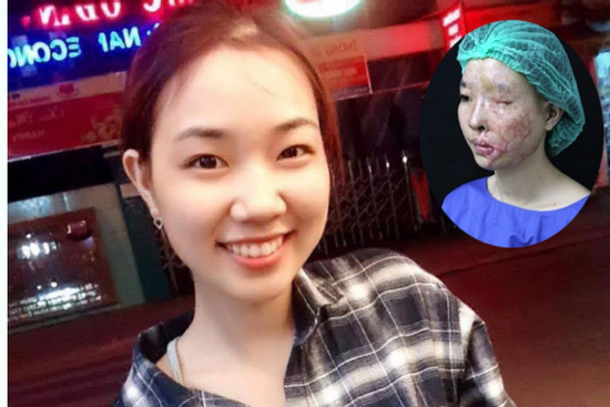 Hành trình phi thường của nữ sinh Đắk Lắk bị tạt axit nhầm sau 10 năm