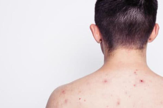 Nam thanh niên 23 tuổi nhiễm HIV sau khi tham gia lễ hội té nước tại Thái Lan