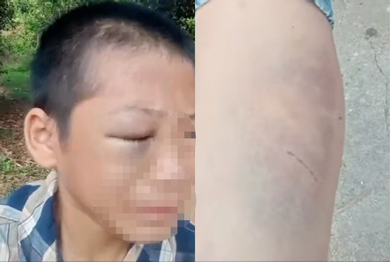 Xác minh clip bé trai mắt bầm tím, khóc kêu cứu vì 'nhiều lần bị đánh đập'
