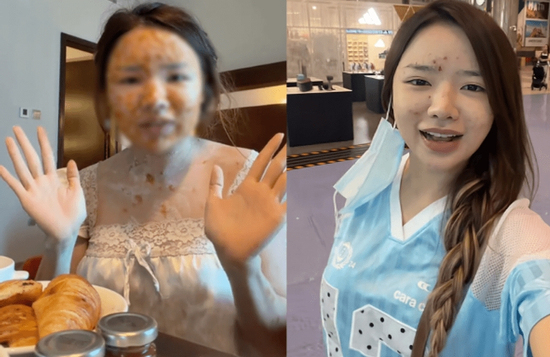 Sau gần nửa tháng cách ly tại Dubai vì mắc thủy đậu, TikToker Việt cập nhật tình trạng hiện tại