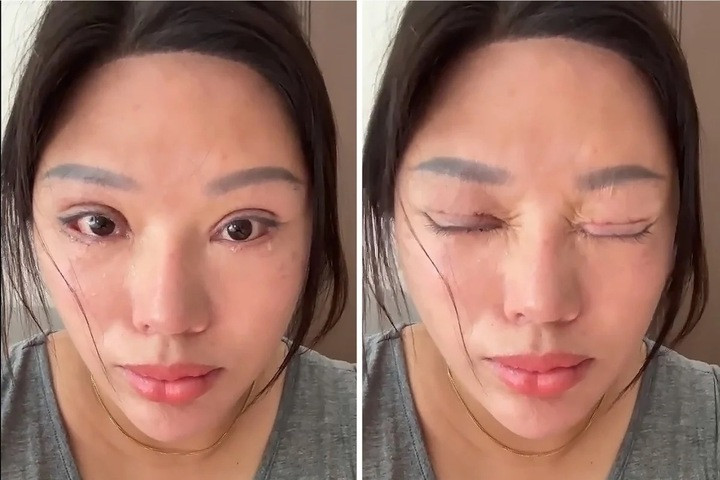 Người phụ nữ liên tục chảy nước mắt do di chứng của phẫu thuật hỏng.