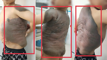Bé trai Hà Nội mang khối u khổng lồ như 'mai rùa' đến gặp bác sĩ: Sau 7 năm lần đầu tiên đứng thẳng