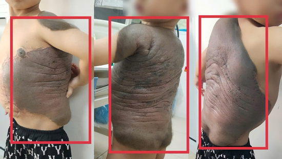 Bé trai Hà Nội mang khối u khổng lồ như 'mai rùa' đến gặp bác sĩ: Sau 7 năm lần đầu tiên đứng thẳng