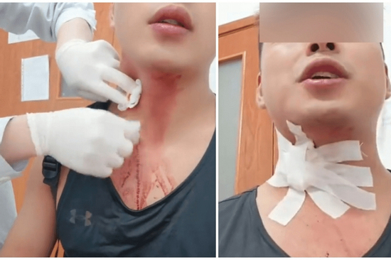 Khó tin: Nhập viện do vỡ tĩnh mạch sau khi cố đập... muỗi