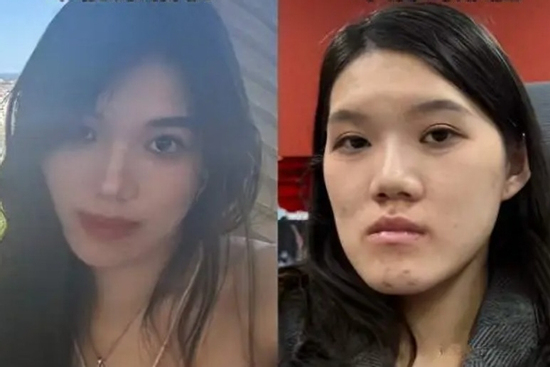 Từ móm nhẹ thành mặt 'lưỡi cày' sau ca phẫu thuật thẩm mỹ, cô gái 'khóc thét' trước lời giải thích của bác sĩ