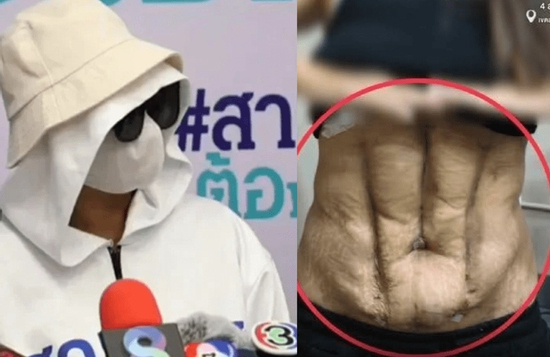 Sốc phần bụng biến dạng của người phụ nữ sau ca phẫu thuật 'cơ bụng số 11' giá rẻ tại phòng khám nổi tiếng